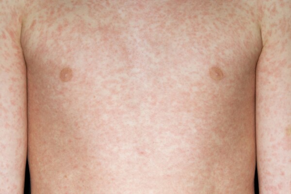Measles Outbreak
